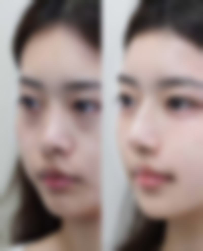 重度黑眼圈眼袋怎么去除：联合治疗 1 + 1 > 2 的成效