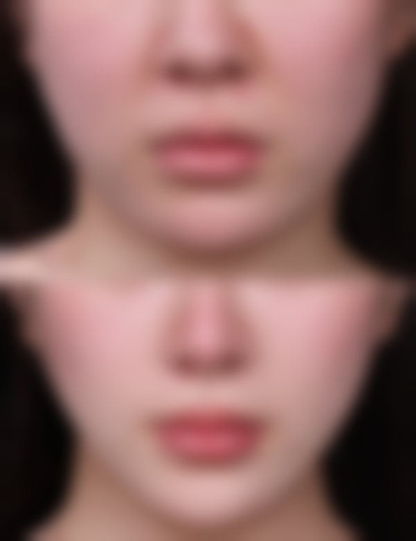 怎样祛除眼袋泪沟之医美填充急救方案