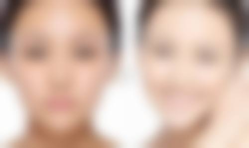 自体脂肪填充眼袋能保持多久之常见QA