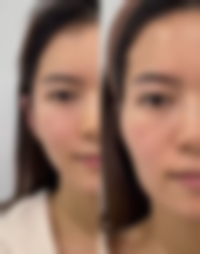 生姜敷眼袋的成效如何：短期与长期、不同类型眼袋的差异