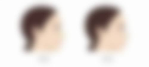 上海医院双眼皮埋线成效之动态重睑理念优势