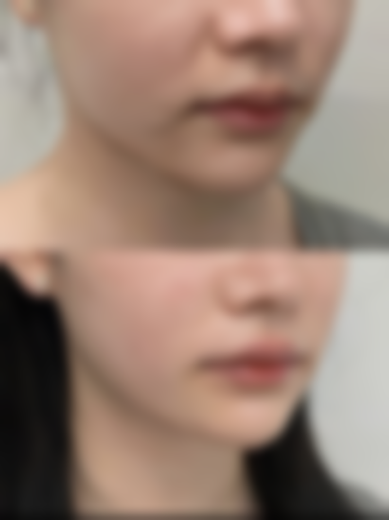 开眼角与双眼皮联合手术的风险考量：美丽也是要付出代价的