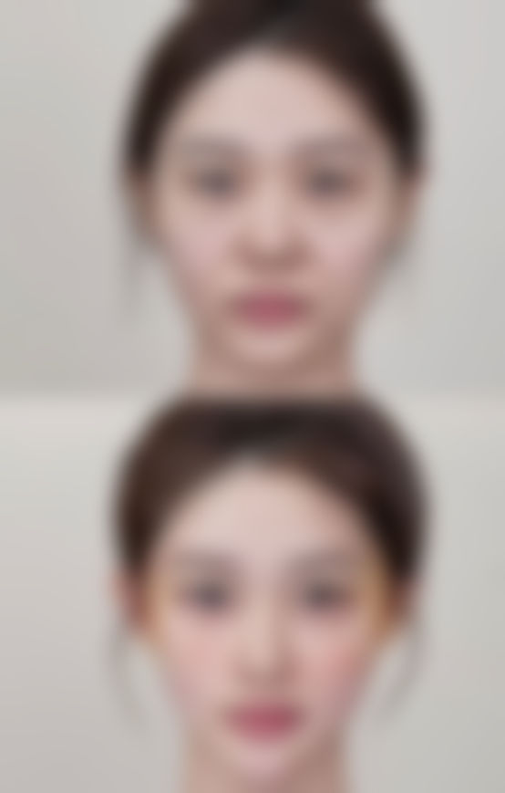 开眼角与双眼皮联合手术的惊艳成效：让你的眼睛“放大招”