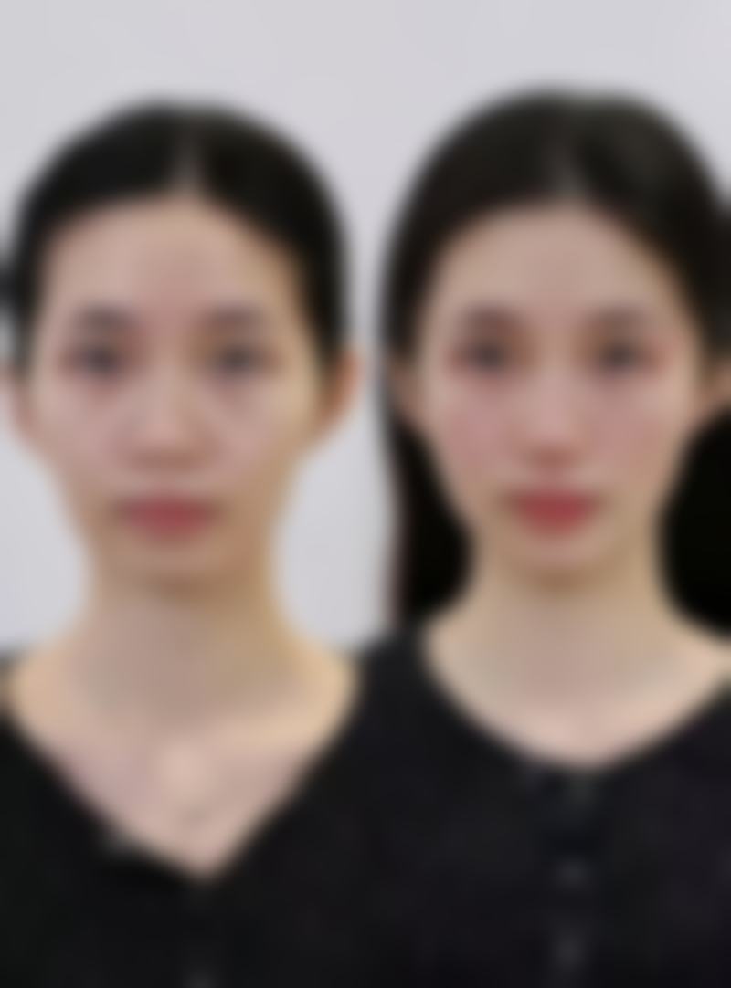 埋线双眼皮适用人群与注意事项之精细把握