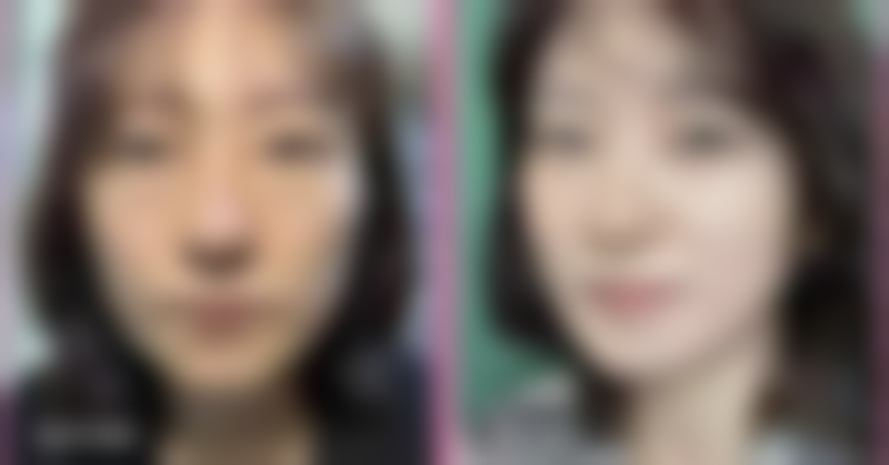 开眼角与双眼皮联合手术的适合人群与医院选择：找到你的“专属定制”