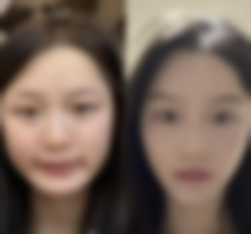 开眼角与双眼皮联合手术的费用大盘点：1 - 3万的投资值不值？