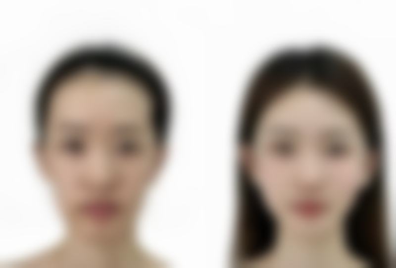 上海德琳医疗美容医院（男性私密中 心）乐威技术特点之术后修复要点