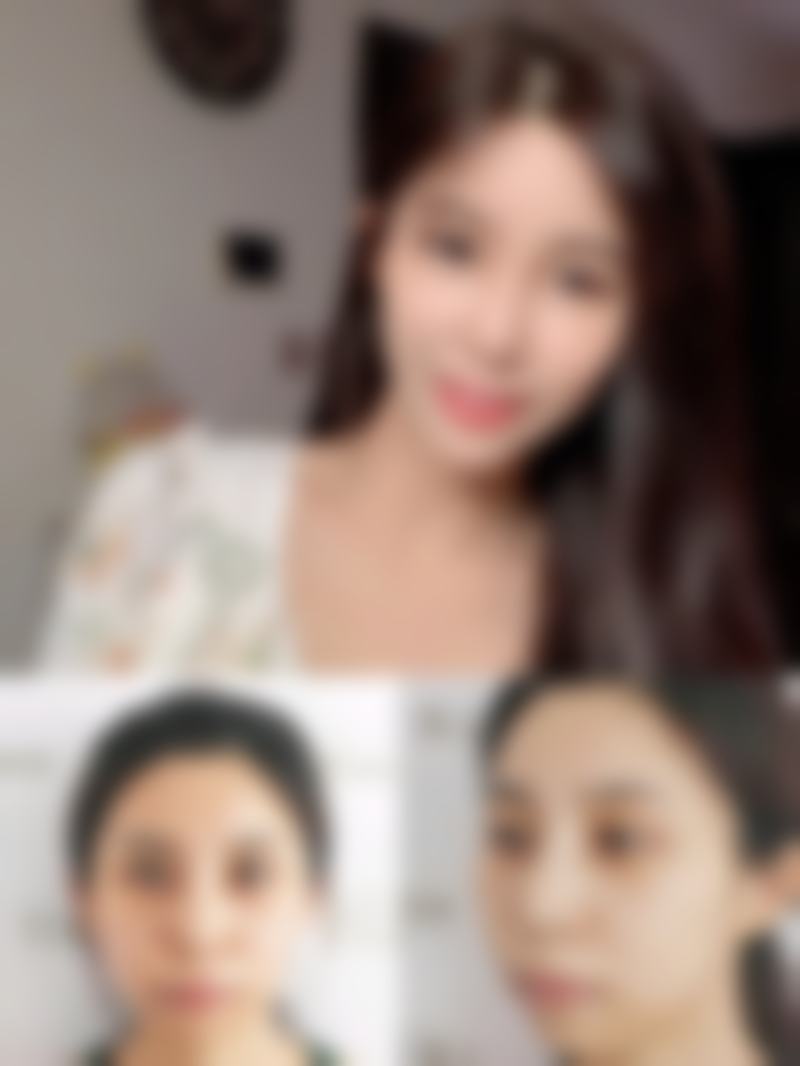 儿童点痣疤痕怎么特殊处理