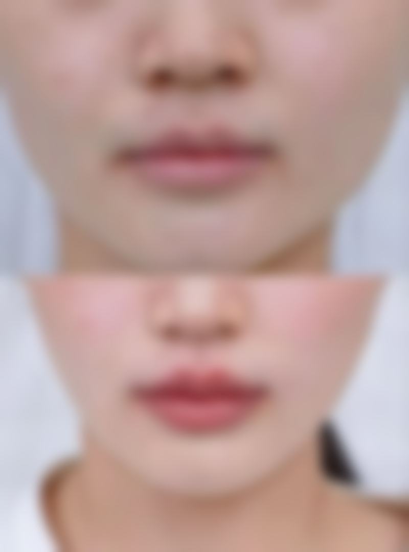 切开双眼皮可以维持多久：个人体质是隐藏助力