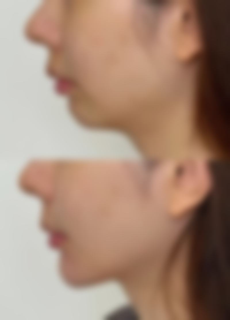 头发种植保持时间的影响因素：医院技术、个人体质与术后护理决定你的头发“保质期”