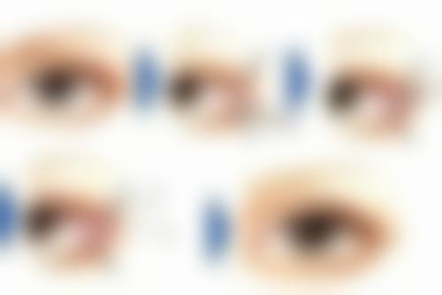 武汉市第一医院分享疤痕疙瘩消退实例