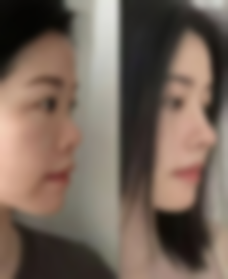 识别哪些疤痕疙瘩更可能自然萎缩