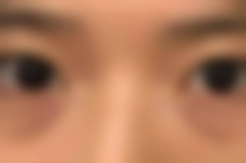 凸出疤痕怎样变平之激光高新科技“熨平”