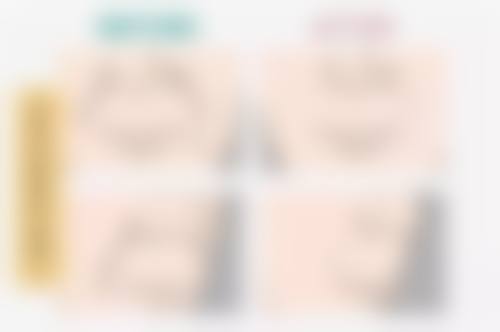 乳房大抽脂,需要住院吗