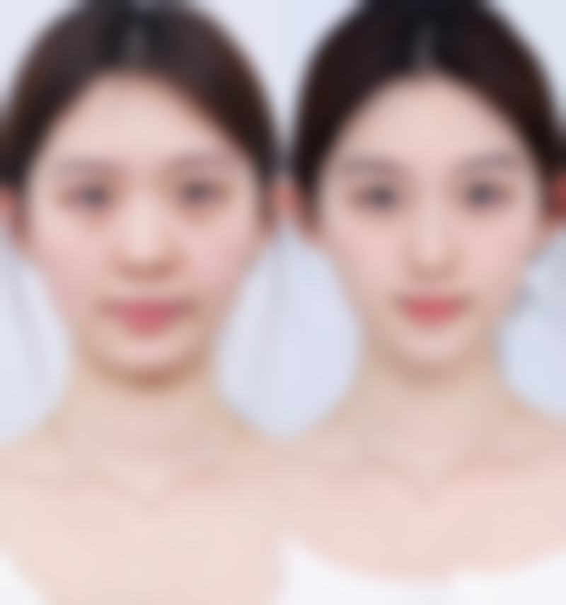 隆胸后把假体取出，身体修复能力与变形程度的关联