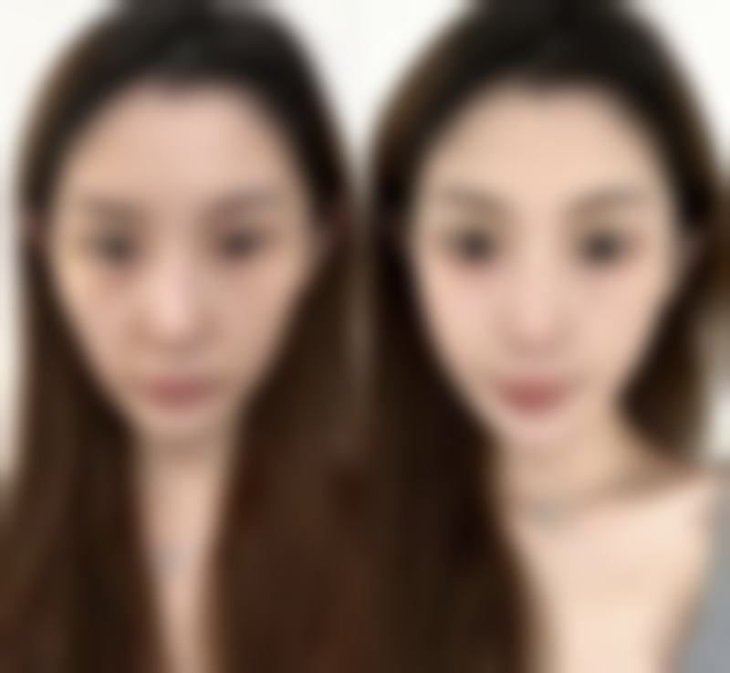 做去眼袋手术注意什么——修复阶段悉心呵护