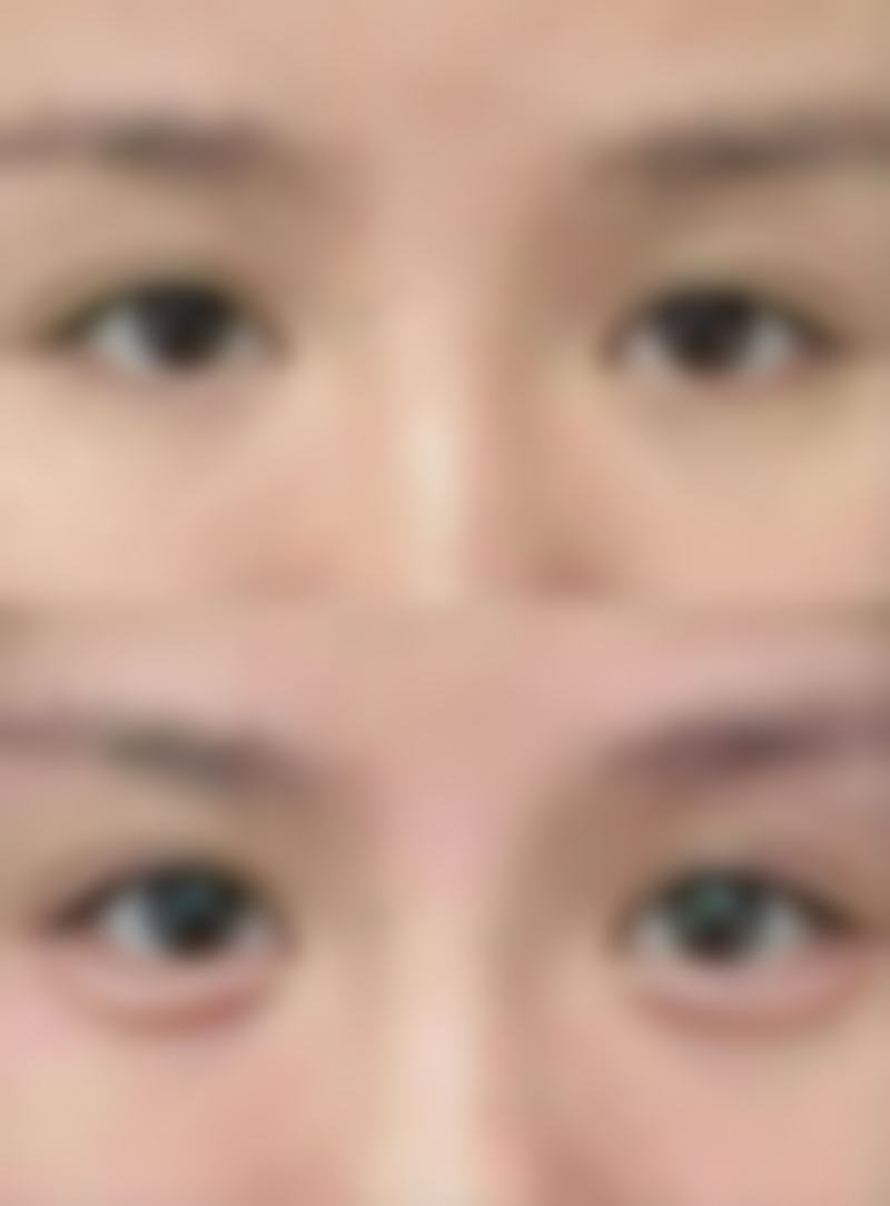 凸出疤痕怎样变平之自然淡化小妙招