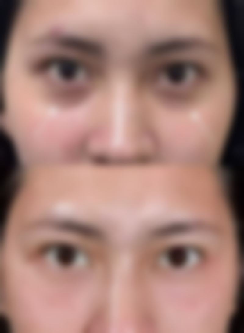 膨体隆鼻的寿命有多长：15年寿命的“亲和组织骨干医生”