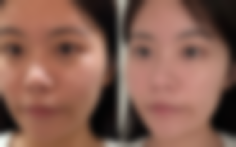 肋软骨隆鼻的寿命有多长：10 - 20年的“持久战将”