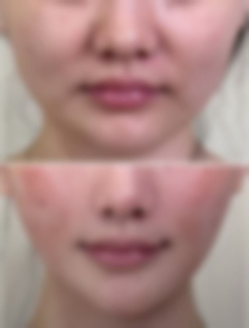 爱贝芙隆鼻是恒久的吗——恒久性影响因素之决定成效持久度的关键