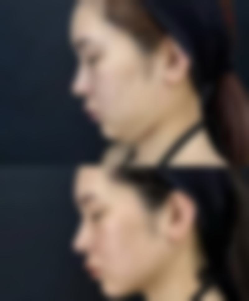 阴道紧缩手术对卵巢的潜在威胁