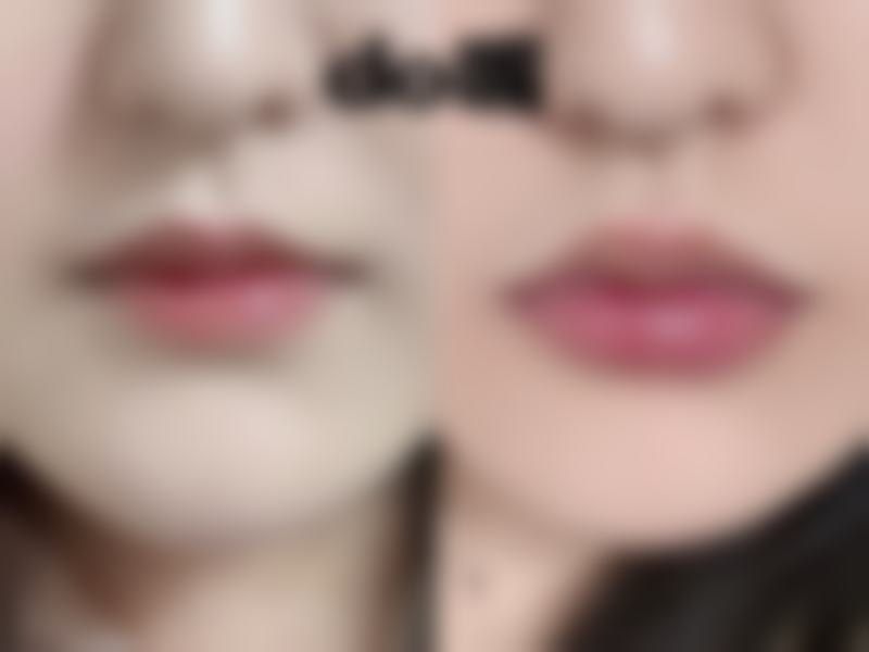 阴道紧缩手术对子宫的伤害风险