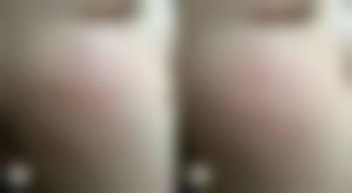 埋线双眼皮一个月水肿不消之个体差异原因剖析