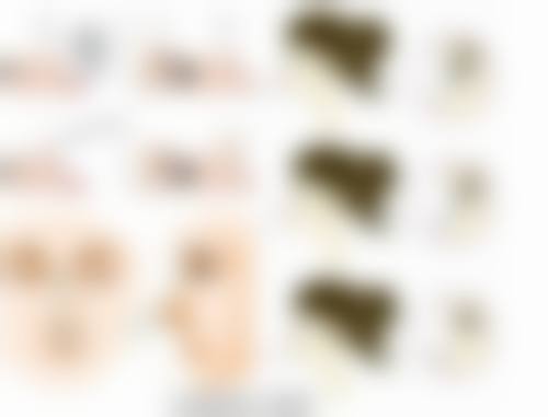 埋线双眼皮何时应该就医之情况说明