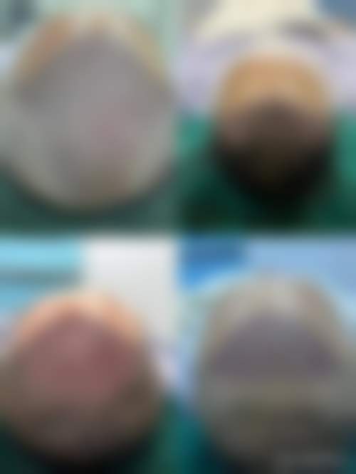 昆明雍禾植发医院口碑好不好