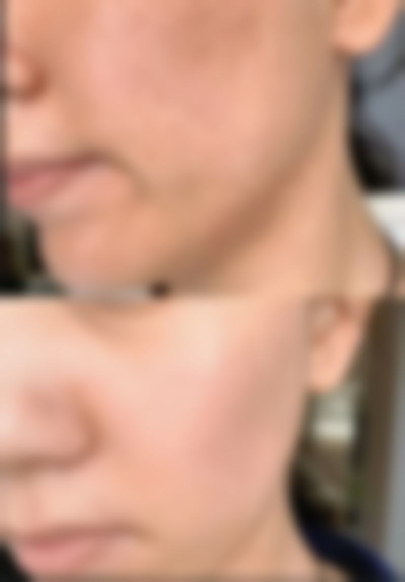 埋线双眼皮一个月仍水肿之冷热敷交替消肿法