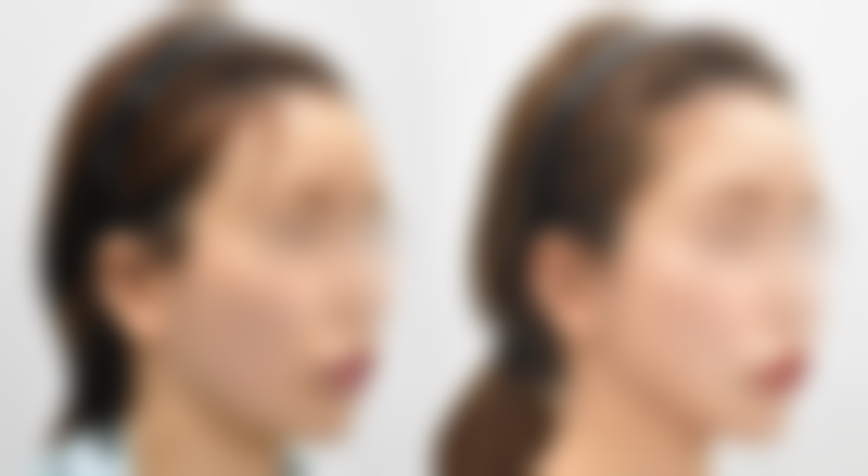 假体隆胸可以用力抓吗：修复后适度可行