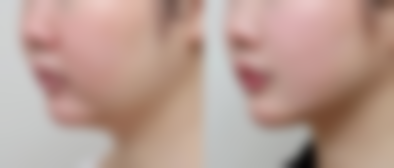 埋线双眼皮常见护理误区之多揉眼睛帮助消肿