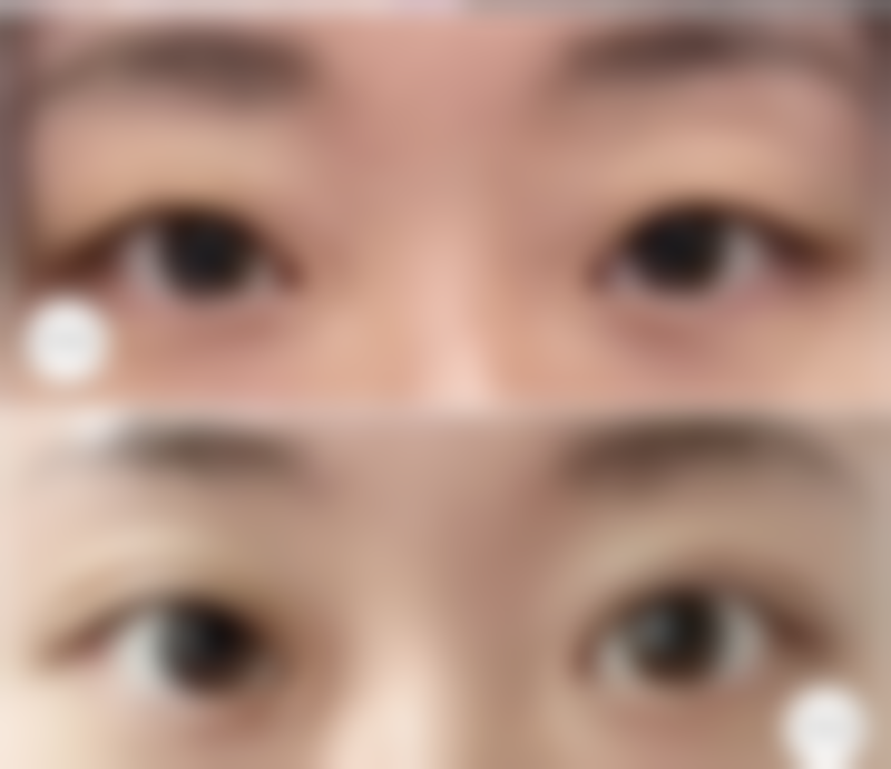 假体隆胸可以用力抓吗：进口与国产假体差异不大