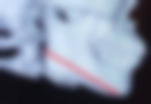 熬夜有黑眼圈眼袋怎么消除:医美方法