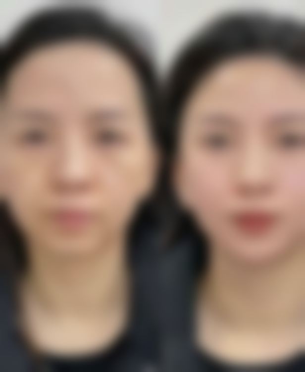 双眼皮做哪种最好？埋线法自然无痕，切开法持久塑形，选对术式是关键