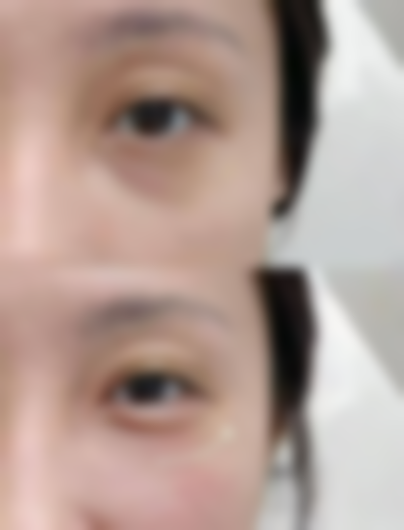 定点法双眼皮：折中选择优势多的特色医院揭秘