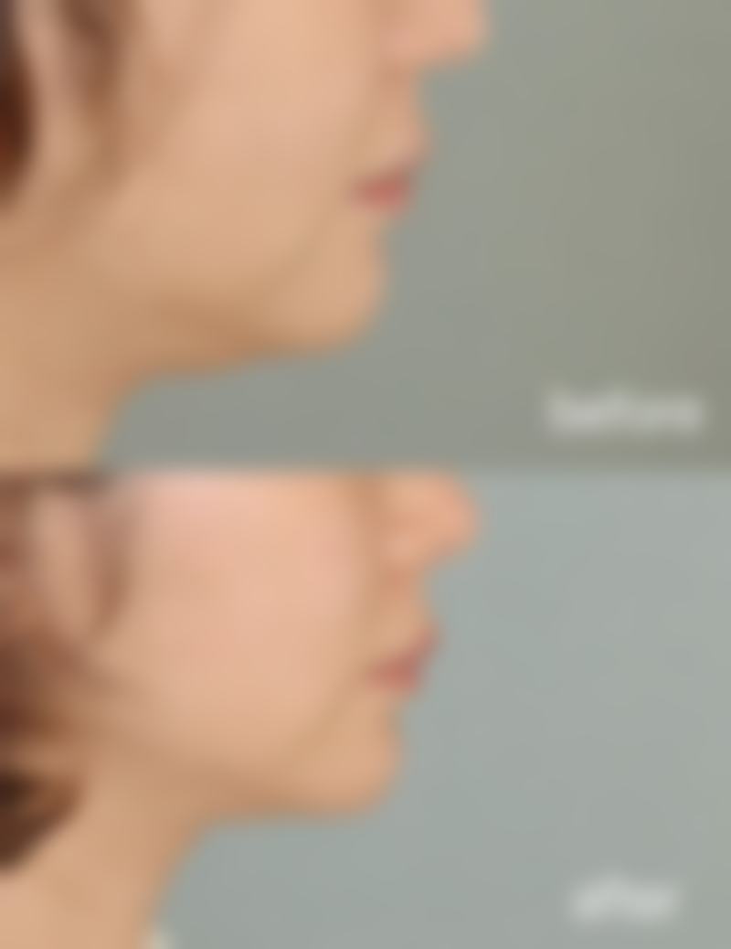 打了瘦脸针脸上凹凸怎么办:终极预防指南