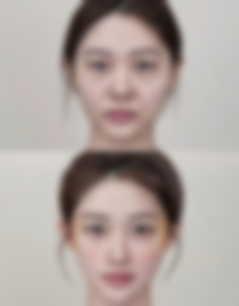 欧式双眼皮：深邃立体混血感打造的优质医院盘点