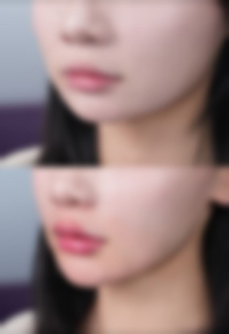 特殊双眼皮后多久可以洗脸:欧式、扇形、新月形眼型护理