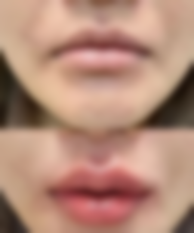 韩式双眼皮后多久可以洗脸:时间与护理要点