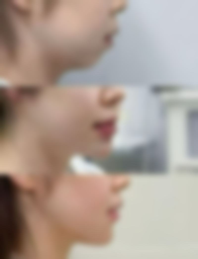 尾段：告别刀疤，重拾自信