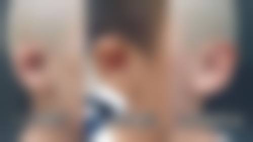 骨粉隆鼻取出的方法：微创技术带来福音