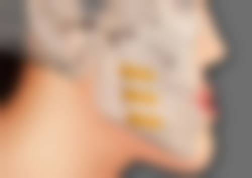 40岁女人眼袋怎么去：医美非手术项目——无创去眼袋新选择