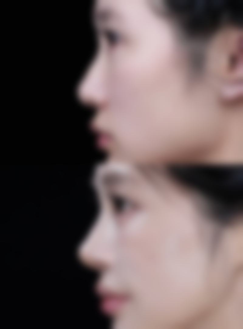 面部抽脂一般要多少——时间篇