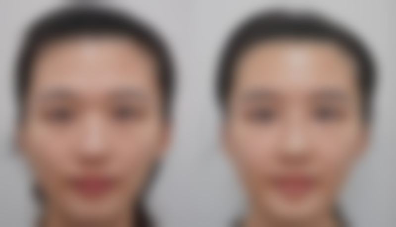 全身抽脂怎么抽的：安心规范不容忽视