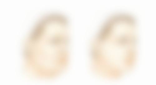 烧伤疤痕一般多久可以淡化：耐心值拉满，1年起算