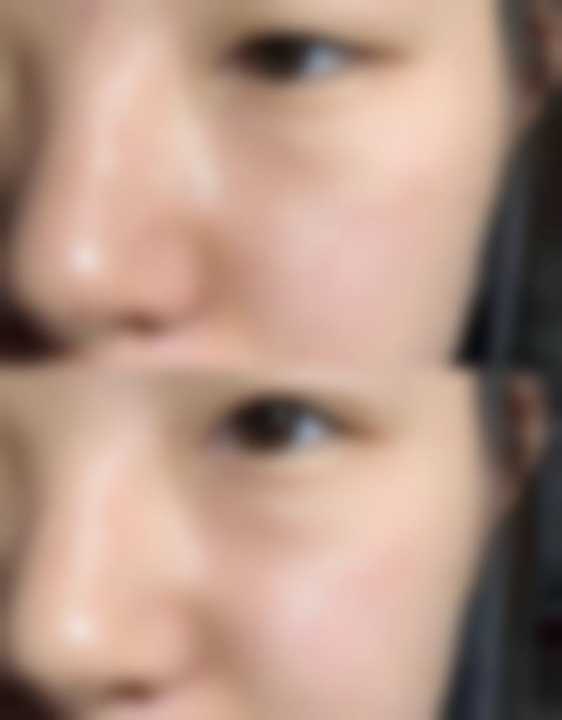 瘦脸针一般多少个单位:男女剂量差异剖析