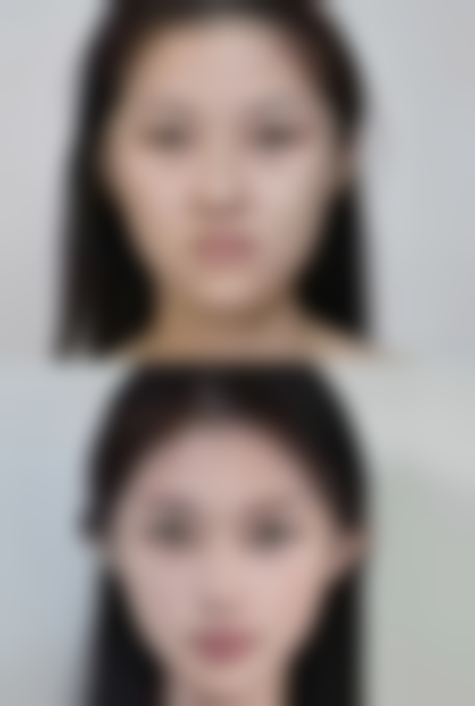 疤痕有什么方法可以去掉——按摩篇：手指“舞蹈”，促进循环