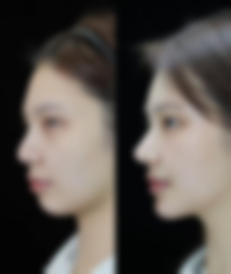 尾段:告别熊猫眼,重拾自信笑容