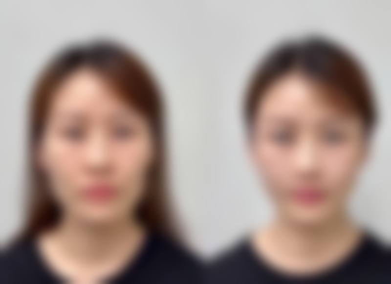 去除黑眼袋用什么——美容仪器篇:高新科技助攻